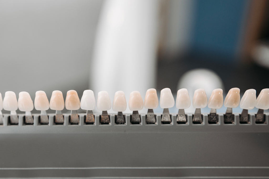 Onlays-Inlays-Facettes-céramiques